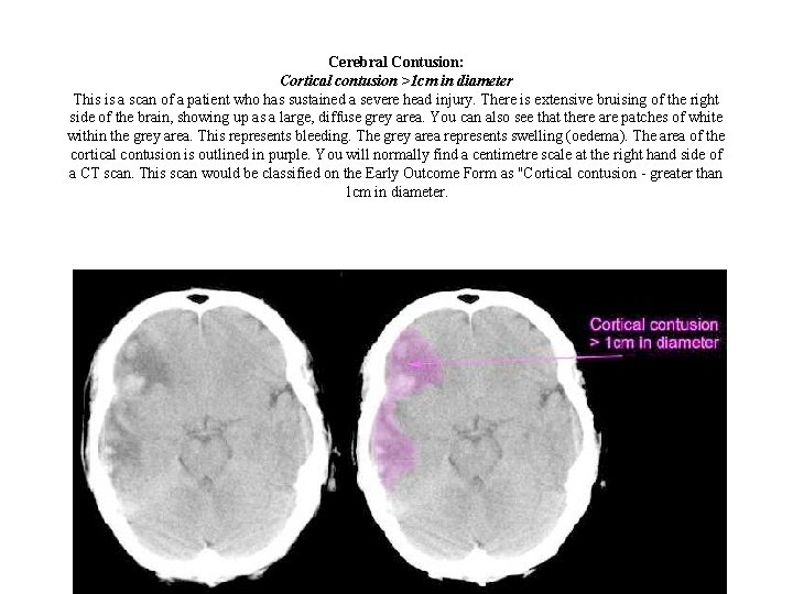 Cerebral Contusion: Cortical contusion >1 cm in diameter This is a scan of a