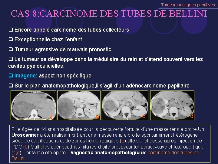 Tumeurs malignes primitives CAS 8: CARCINOME DES TUBES DE BELLINI q Encore appelé carcinome