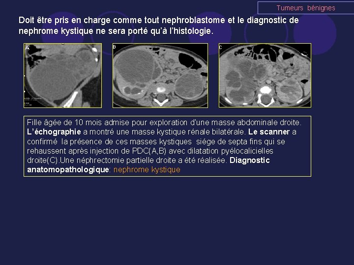 Tumeurs bénignes Doit être pris en charge comme tout nephroblastome et le diagnostic de