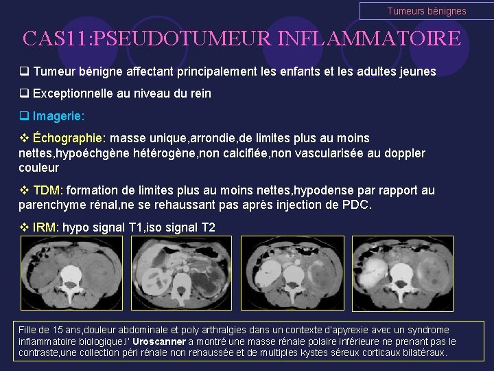 Tumeurs bénignes CAS 11: PSEUDOTUMEUR INFLAMMATOIRE q Tumeur bénigne affectant principalement les enfants et