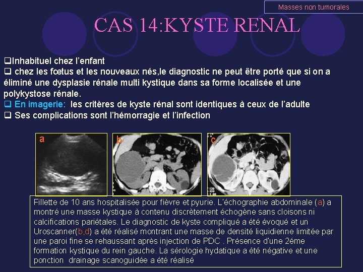 Masses non tumorales CAS 14: KYSTE RENAL q. Inhabituel chez l’enfant q chez les