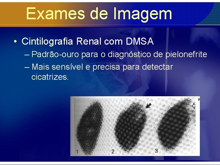 Exames de Imagem • Cintilografia Renal com DMSA – Padrão-ouro para o diagnóstico de