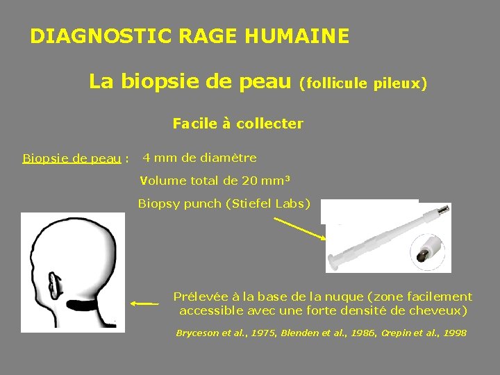  DIAGNOSTIC RAGE HUMAINE La biopsie de peau (follicule pileux) Facile à collecter Biopsie
