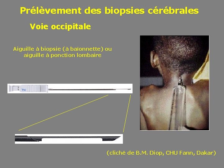 Prélèvement des biopsies cérébrales Voie occipitale Aiguille à biopsie (à baïonnette) ou aiguille à