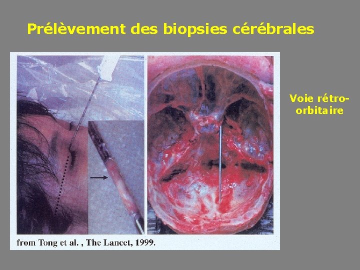 Prélèvement des biopsies cérébrales Voie rétroorbitaire 