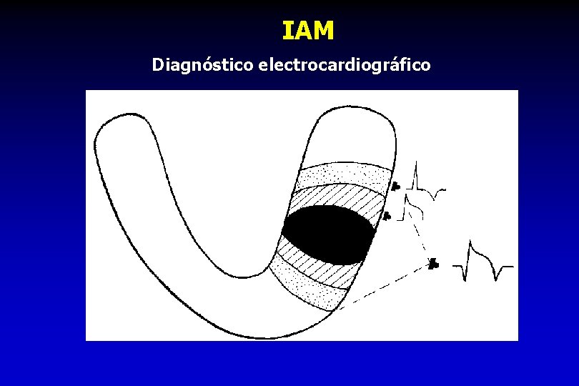 IAM Diagnóstico electrocardiográfico 