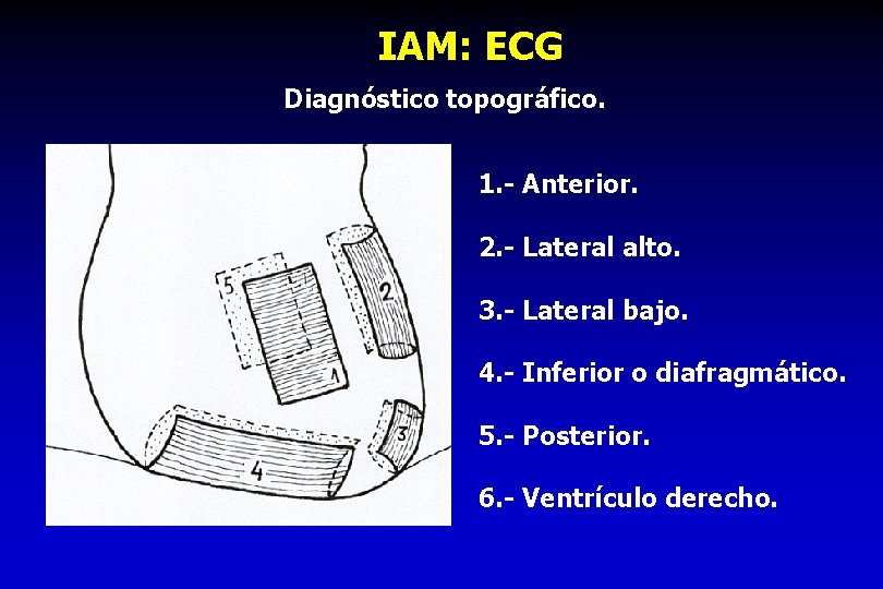 IAM: ECG Diagnóstico topográfico. 1. - Anterior. 2. - Lateral alto. 3. - Lateral