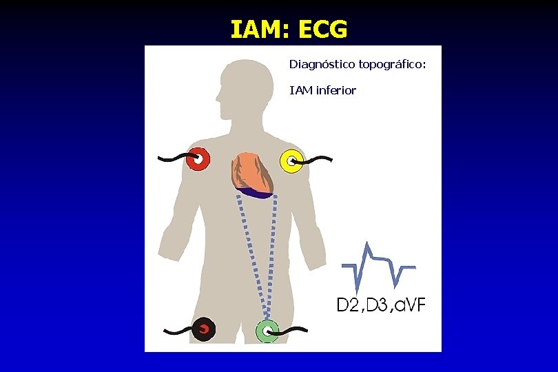 IAM: ECG Diagnóstico topográfico: IAM inferior 