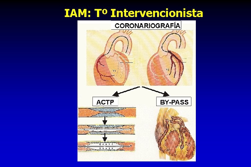 IAM: Tº Intervencionista 