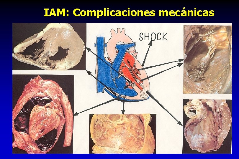 IAM: Complicaciones mecánicas 