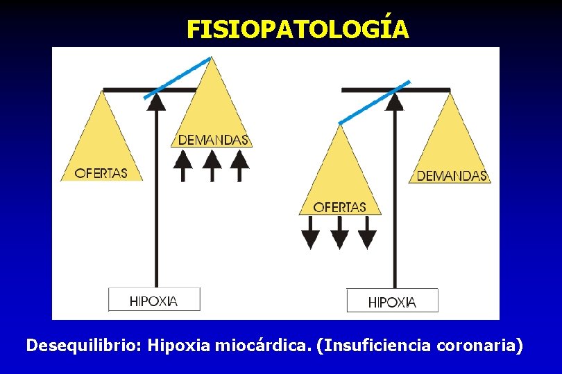 FISIOPATOLOGÍA Desequilibrio: Hipoxia miocárdica. (Insuficiencia coronaria) 