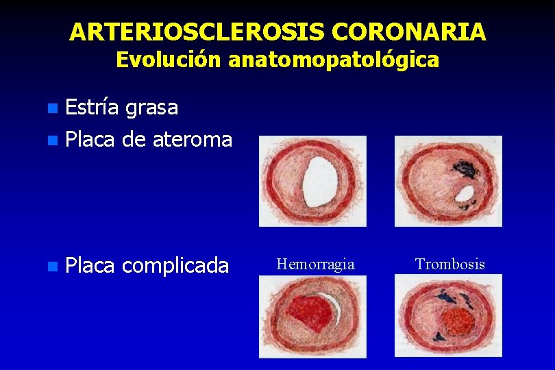 ARTERIOSCLEROSIS CORONARIA Evolución anatomopatológica Estría grasa n Placa de ateroma n n Placa complicada