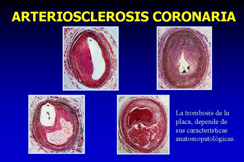 ARTERIOSCLEROSIS CORONARIA La trombosis de la placa, depende de sus características anatomopatológicas. 
