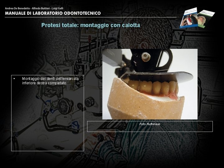 Protesi totale: montaggio con calotta • Montaggio dei denti dell’emiarcata inferiore destra completato. Foto