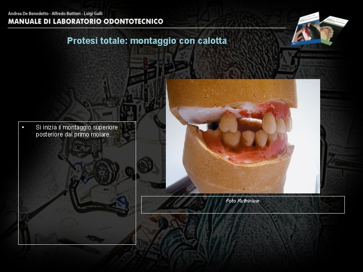 Protesi totale: montaggio con calotta • Si inizia il montaggio superiore posteriore dal primo