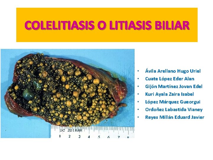 COLELITIASIS O LITIASIS BILIAR • • Ávila Arellano Hugo Uriel Cuate López Eder Alan