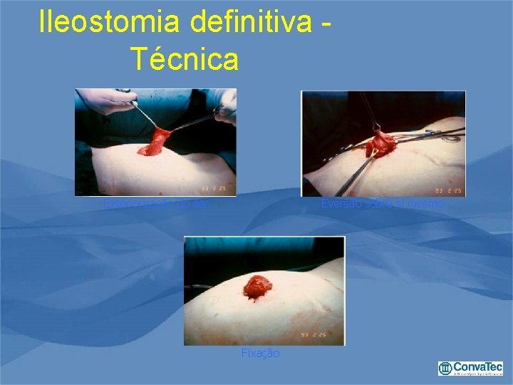 Ileostomia definitiva - Técnica Exteriorização do íleo Eversão sobre si mesmo Fixação 