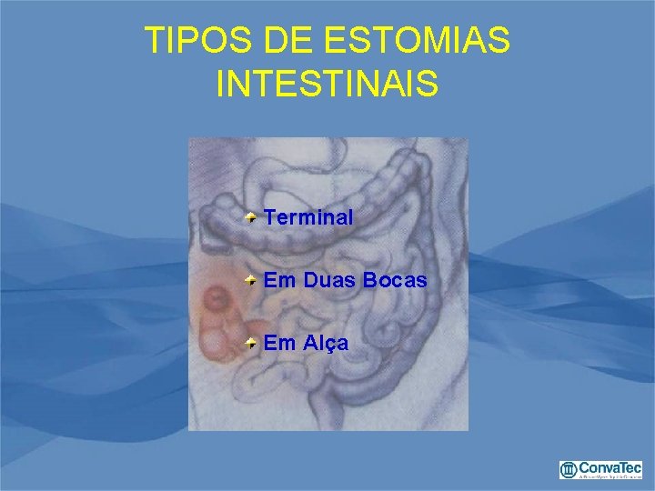 TIPOS DE ESTOMIAS INTESTINAIS Terminal Em Duas Bocas Em Alça 