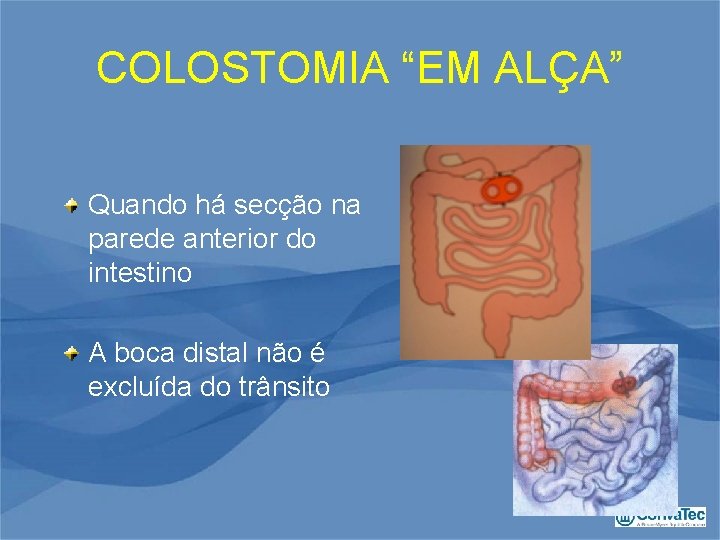 COLOSTOMIA “EM ALÇA” Quando há secção na parede anterior do intestino A boca distal