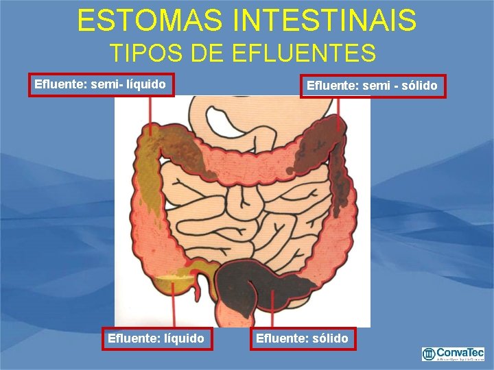  ESTOMAS INTESTINAIS TIPOS DE EFLUENTES Efluente: semi- líquido Efluente: semi - sólido Efluente: