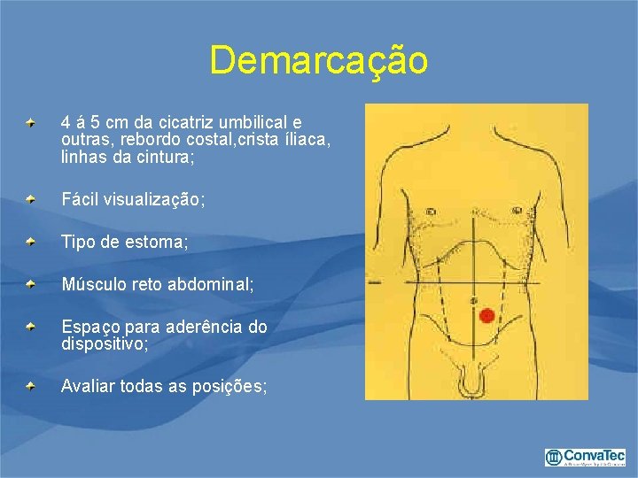 Demarcação 4 á 5 cm da cicatriz umbilical e outras, rebordo costal, crista íliaca,