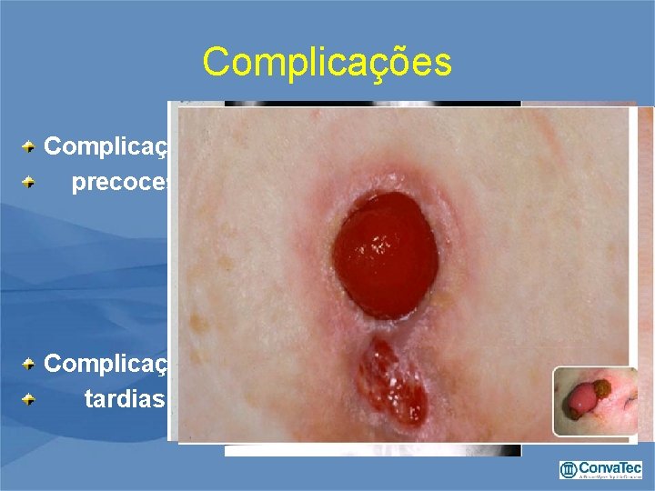 Complicações precoces Sepsi periestomal Necrose Retração Hemorragia Eventración periestomal Complicações tardias Estenose Prolapso Afecções