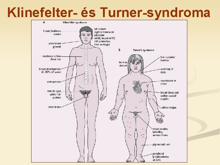 Klinefelter- és Turner-syndroma 