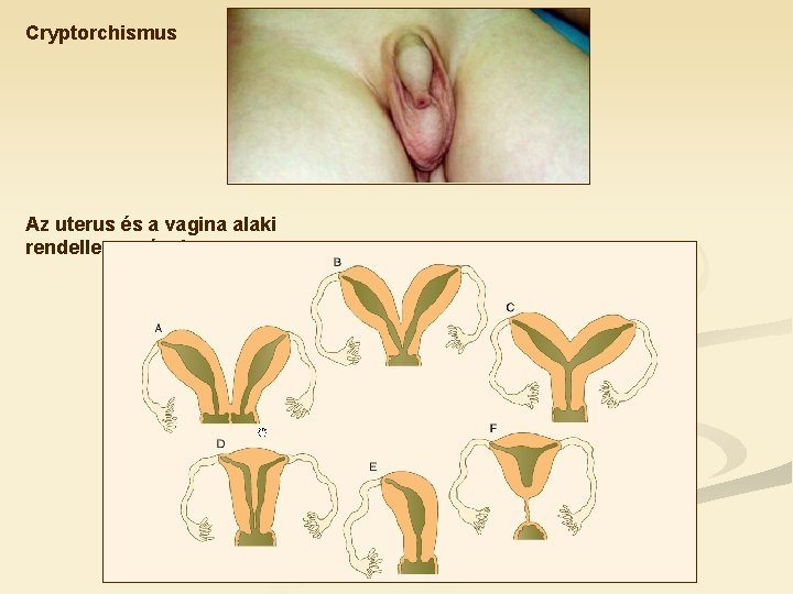 Cryptorchismus Az uterus és a vagina alaki rendellenességei 