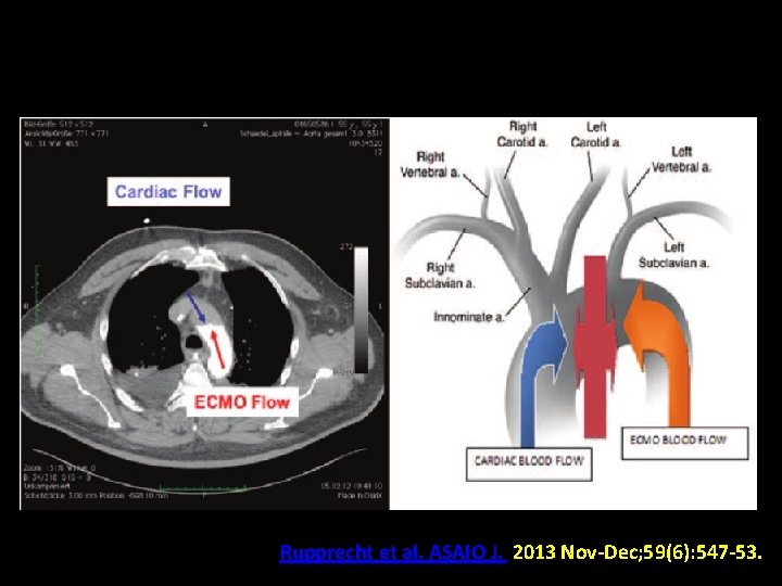 Rupprecht et al. ASAIO J. 2013 Nov-Dec; 59(6): 547 -53. 