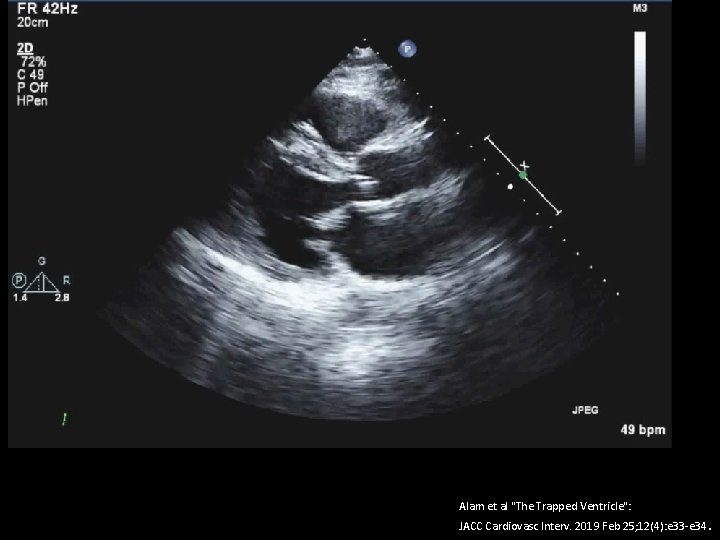 Alam et al "The Trapped Ventricle": JACC Cardiovasc Interv. 2019 Feb 25; 12(4): e
