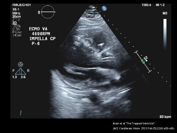 Alam et al "The Trapped Ventricle": JACC Cardiovasc Interv. 2019 Feb 25; 12(4): e
