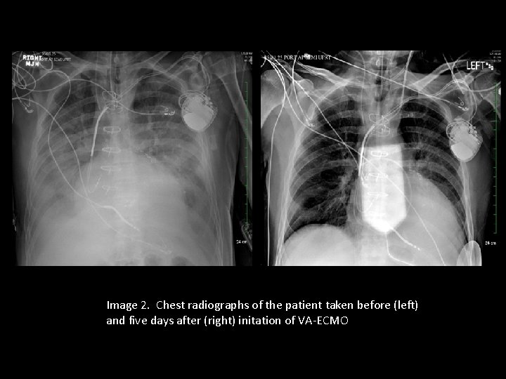 Image 2. Chest radiographs of the patient taken before (left) and five days after