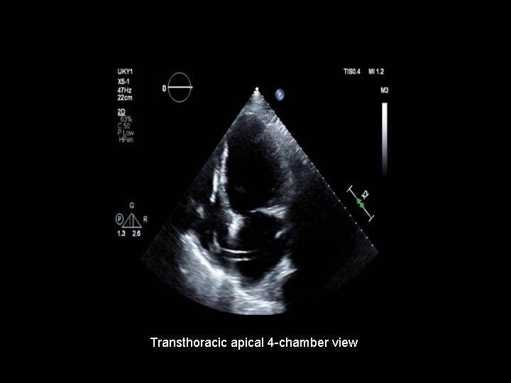 Transthoracic apical 4 -chamber view 