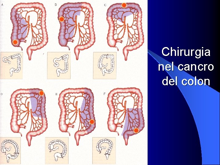 Chirurgia nel cancro del colon 