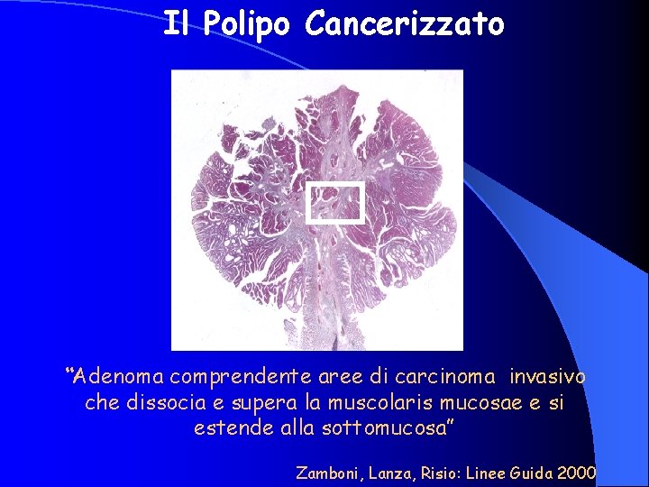 Il Polipo Cancerizzato “Adenoma comprendente aree di carcinoma invasivo che dissocia e supera la