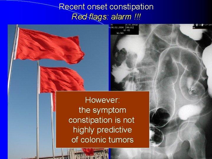 Recent onset constipation Red flags: alarm !!! However: the symptom constipation is not highly