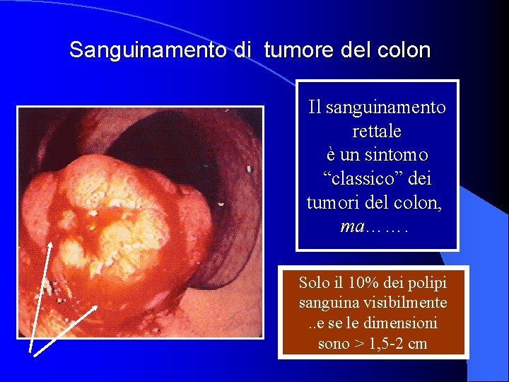 Sanguinamento di tumore del colon Il sanguinamento rettale è un sintomo “classico” dei tumori