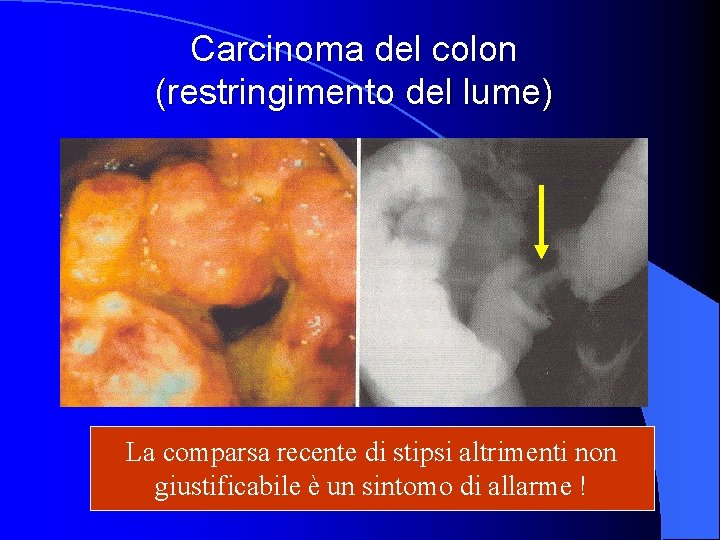 Carcinoma del colon (restringimento del lume) La comparsa recente di stipsi altrimenti non giustificabile