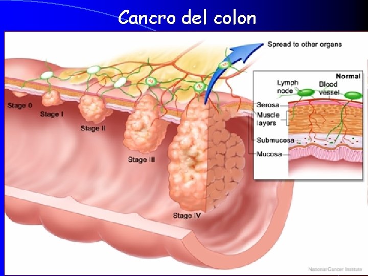 Cancro del colon 