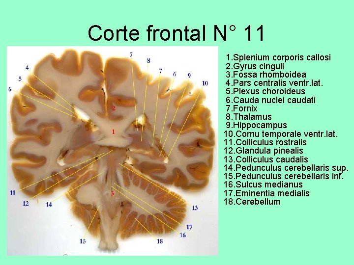 Corte frontal N° 11 • 1. Splenium corporis callosi 2. Gyrus cinguli 3. Fossa