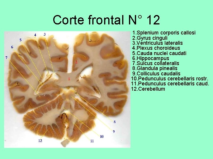 Corte frontal N° 12 • 1. Splenium corporis callosi 2. Gyrus cinguli 3. Ventriculus