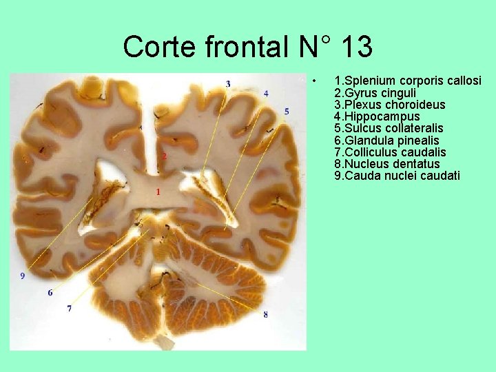 Corte frontal N° 13 • 1. Splenium corporis callosi 2. Gyrus cinguli 3. Plexus