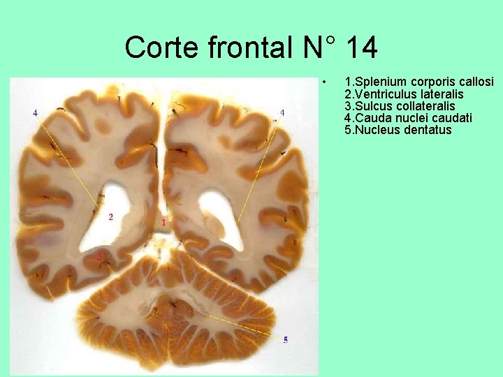 Corte frontal N° 14 • 1. Splenium corporis callosi 2. Ventriculus lateralis 3. Sulcus