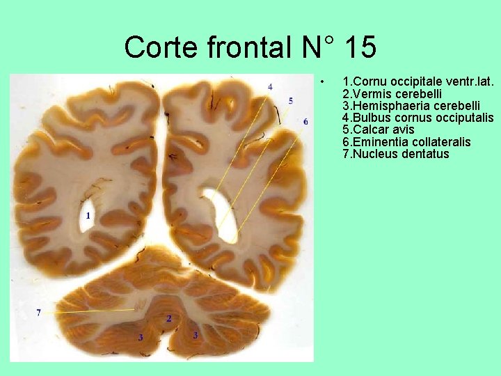 Corte frontal N° 15 • 1. Cornu occipitale ventr. lat. 2. Vermis cerebelli 3.
