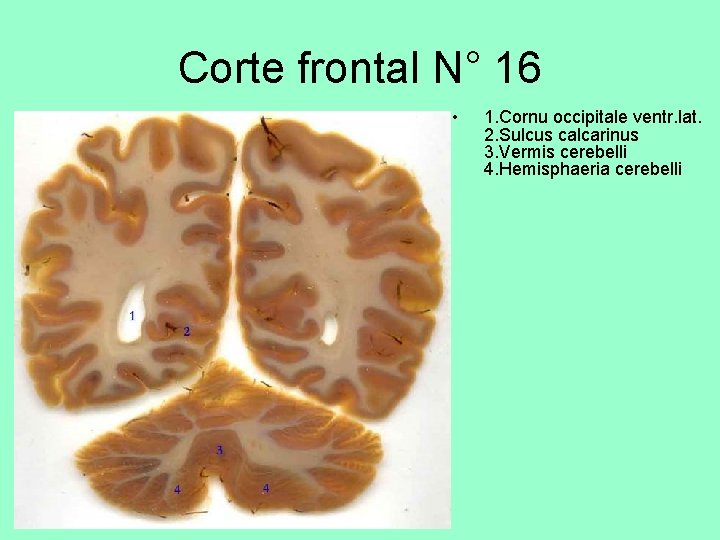 Corte frontal N° 16 • 1. Cornu occipitale ventr. lat. 2. Sulcus calcarinus 3.