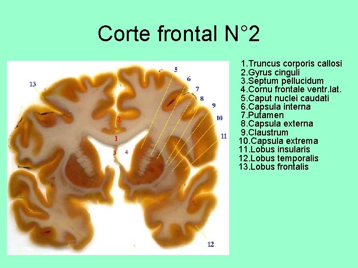Corte frontal N° 2 • 1. Truncus corporis callosi 2. Gyrus cinguli 3. Septum