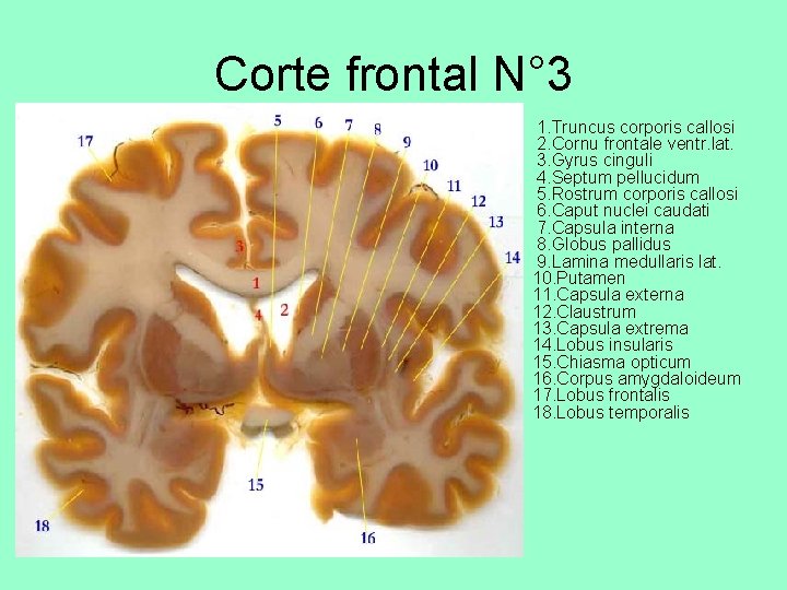 Corte frontal N° 3 • 1. Truncus corporis callosi 2. Cornu frontale ventr. lat.