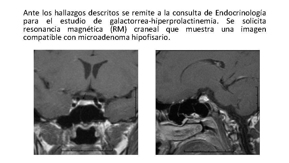 Ante los hallazgos descritos se remite a la consulta de Endocrinología para el estudio