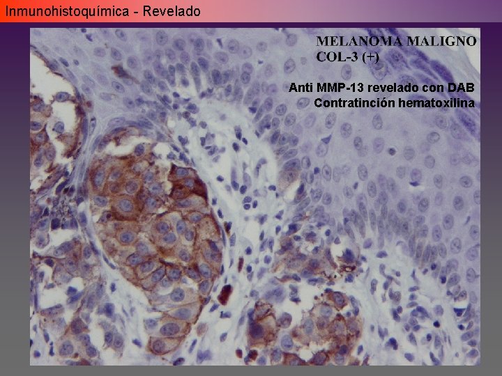 Inmunohistoquímica - Revelado Anti MMP-13 revelado con DAB Contratinción hematoxilina Inmunohistoquímica - Revelado Anti MMP-13 revelado con DAB Contratinción hematoxilina
