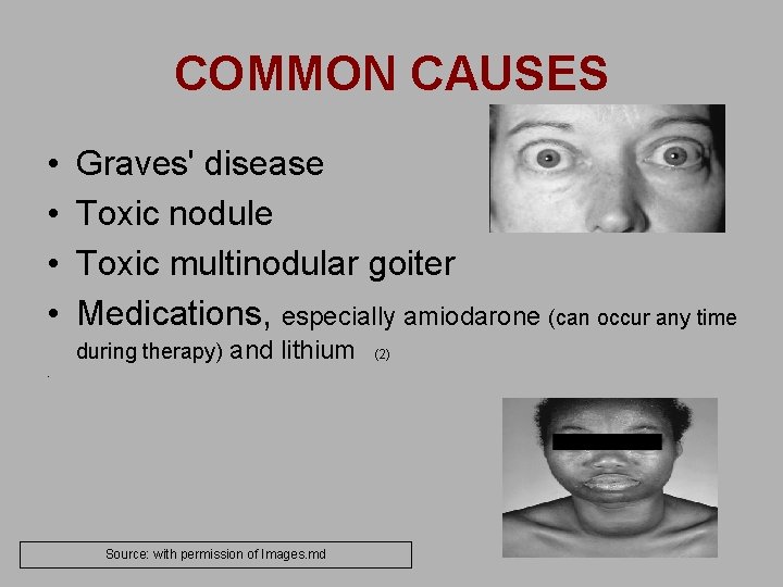 COMMON CAUSES • • Graves' disease Toxic nodule Toxic multinodular goiter Medications, especially amiodarone